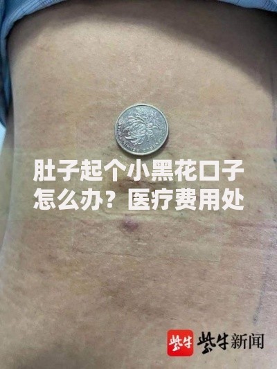 肚子起个小黑花口子怎么办？医疗费用处理与贷款方案解析